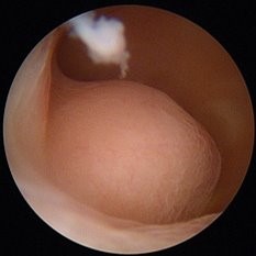 子宮後壁から発生した粘膜下子宮筋腫