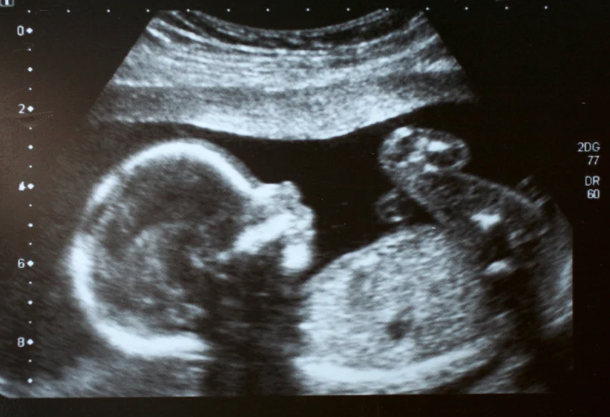 胎児の超音波