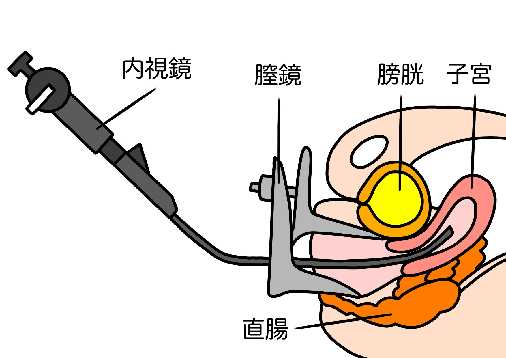 子宮鏡