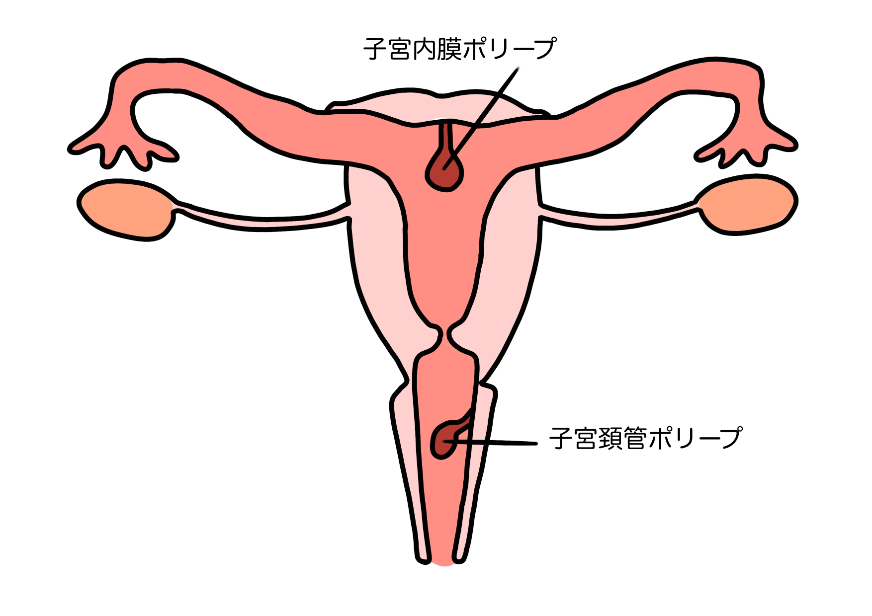 子宮内膜ポリープと子宮頸管ポリープ