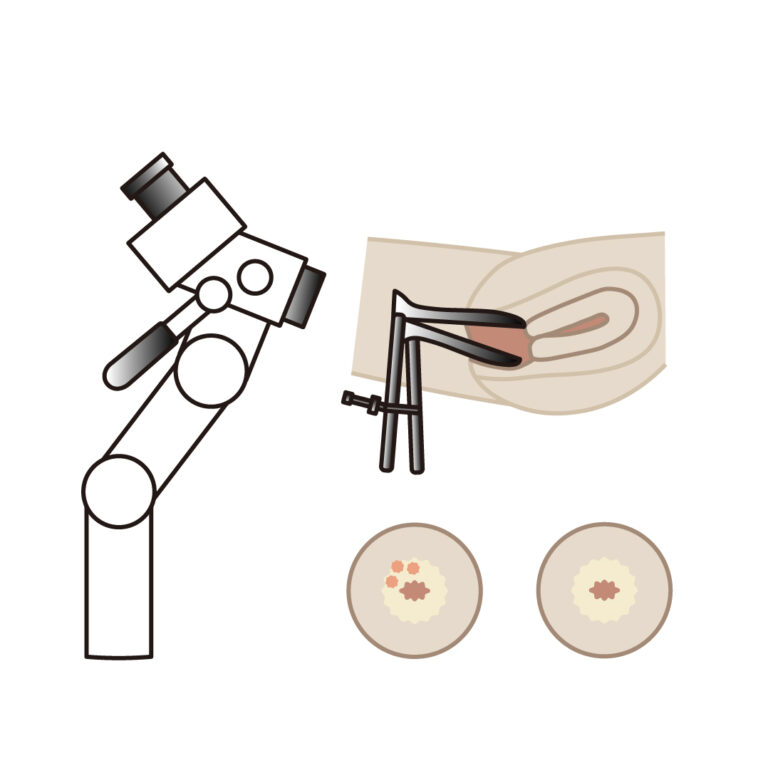 コルポスコピー検査方法